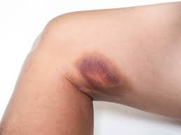 Close-up of a human elbow with a large purple hematoma on the skin.