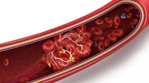 Illustration of a cross-section of a blood vessel showing red blood cells and the causes of blood clots due to plaque buildup.