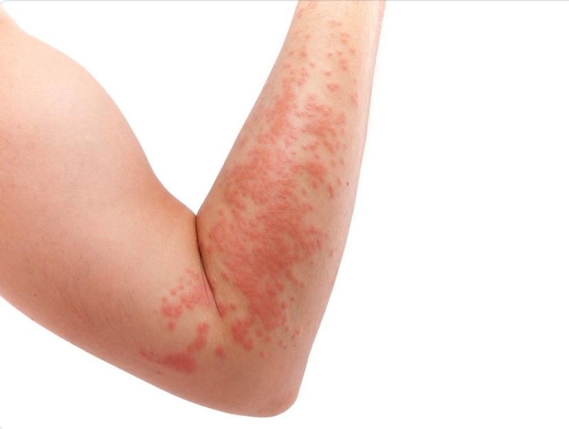 Penicillin allergy