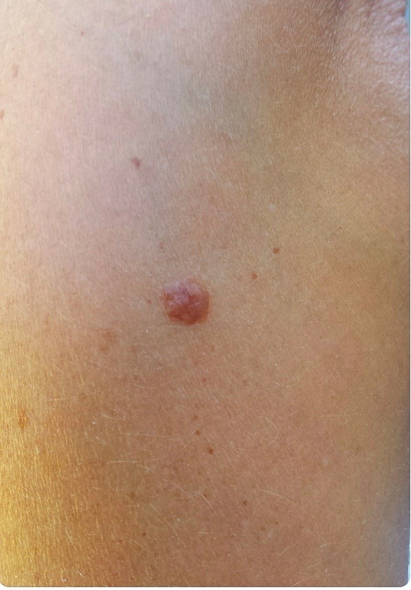 Skin tag