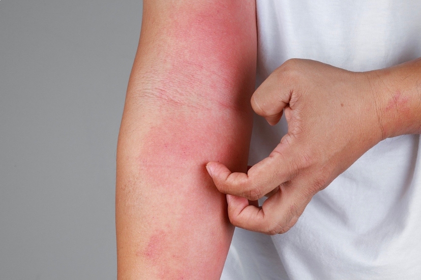Eczema