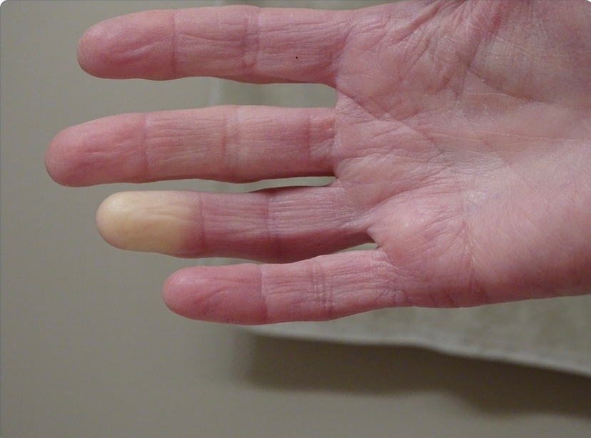 Raynauds