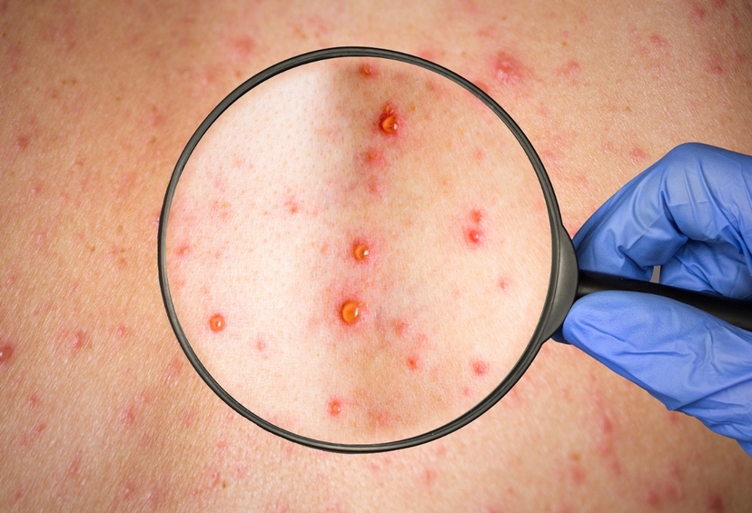 Shingles