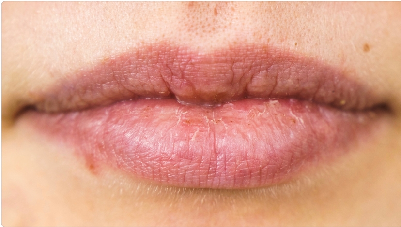 Cold Sore