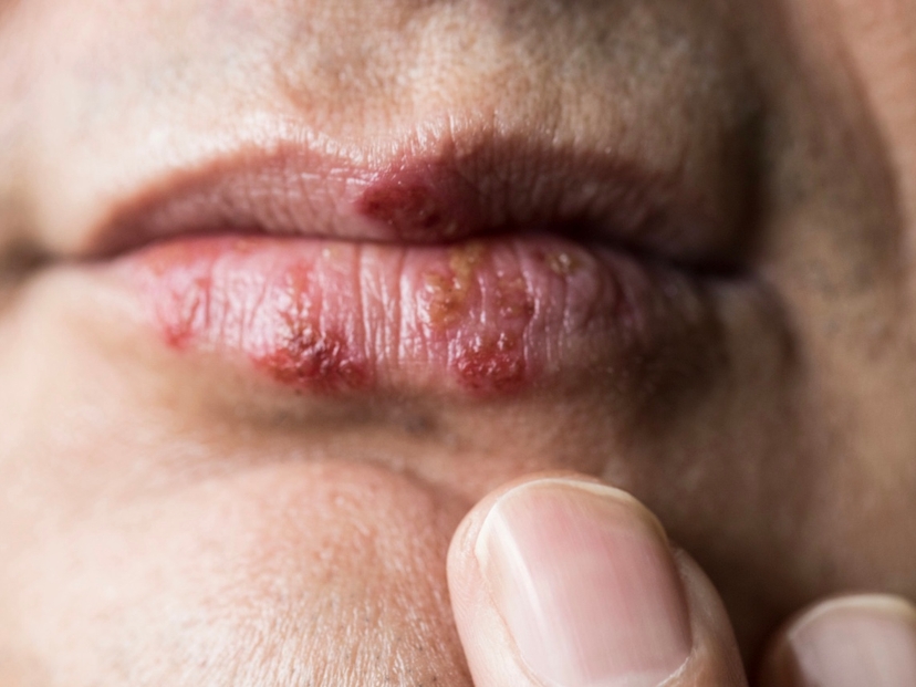 Herpes