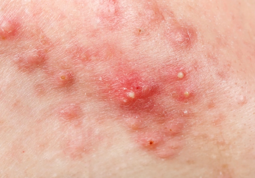 Cystic Acne