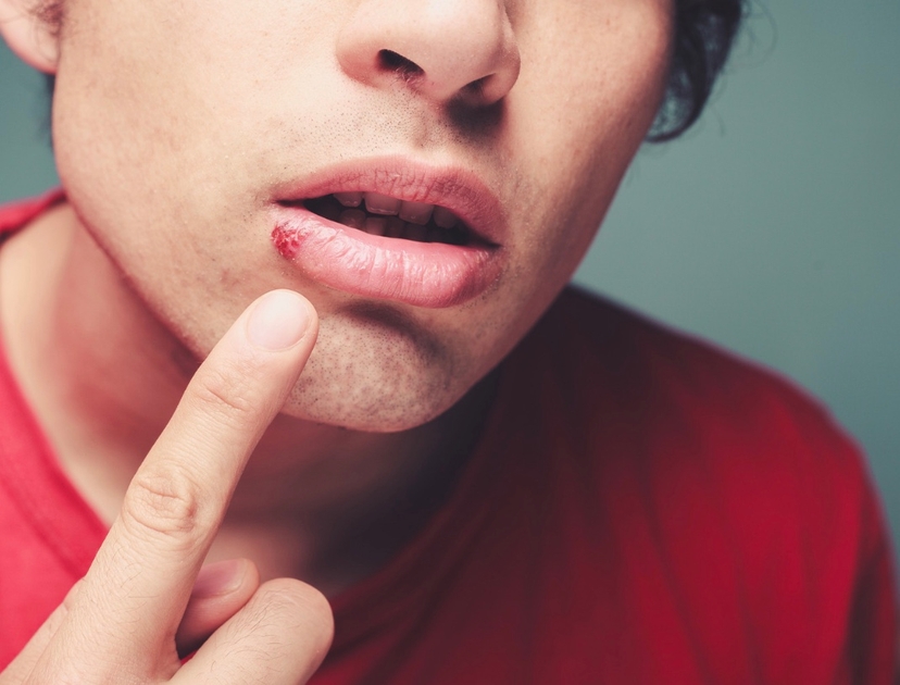 Cold sore