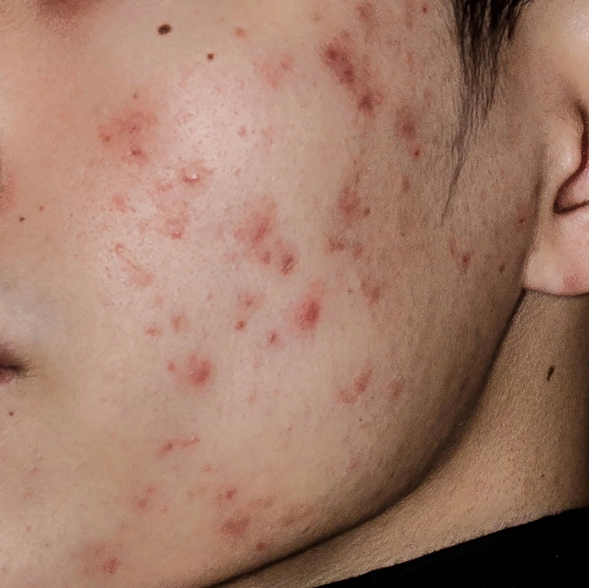 Acne Scar