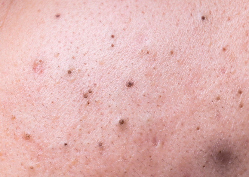 Blackheads