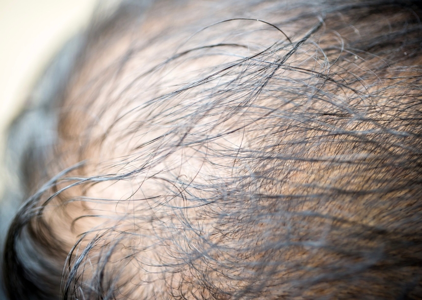 Hair thinning