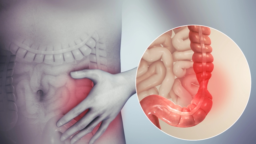 An image of a person experiencing stomach pain due to irritable bowel syndrome (IBS)