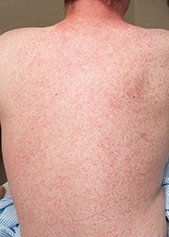 A man with a rash on his back that looks like measles.