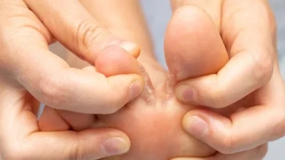 A person's foot is being massaged by a person, providing relief from symptoms of athletes foot.