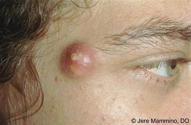 A close up of a person's eye with a red spot.