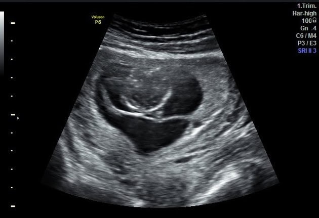 Ultrasound image showing a fetus during the first trimester, displayed with medical metrics and subchorionic hematoma on the right side of the screen.