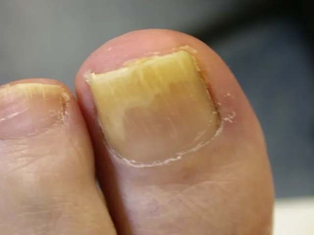 Close-up of a toenail with a yellowed and thickened appearance, possibly indicating causes of a fungal nail infection or other nail condition.