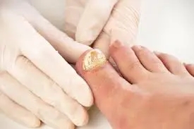 A person wearing white gloves examines a toenail prone to fungal infections.