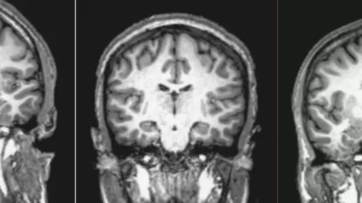 MRI scan of a brain, illustrating structural abnormalities often associated with schizophrenia, a mental health disorder that affects perception of reality