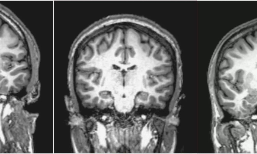 MRI scan of a brain, illustrating structural abnormalities often associated with schizophrenia, a mental health disorder that affects perception of reality