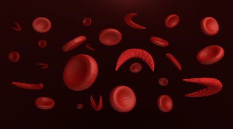 Red blood cells of sickle cell anaemia disease and normal cells