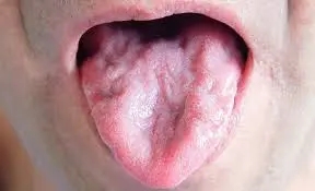 Close-up of a person's tongue showing signs of muscle wasting, a common early symptom of motor neurone disease.