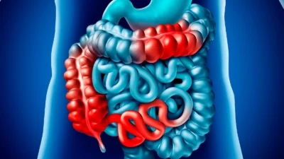 Detailed image of the digestive tract highlighting inflammation, representing the effects and symptoms of Crohn's disease.