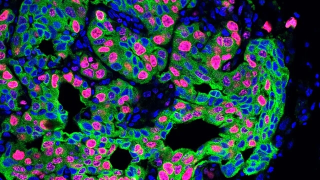 Fluorescent microscopy image showing cells with blue nuclei, green cell membranes, and pink structures within the tissue sample, indicative of changes often associated with asbestos exposure.