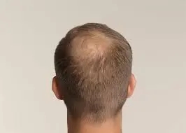 The back of a person's head displays male pattern baldness with significant hair loss on the crown.