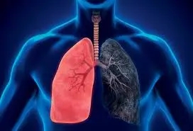 Illustration of a human torso showing two lungs, one healthy in red and one diseased and dark. The trachea and bronchi are also visible, highlighting the importance of asbestosis diagnosis.