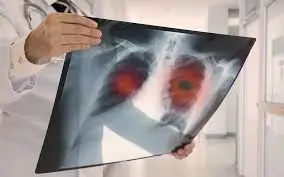 A medical professional holds a chest X-ray showing two highlighted areas in the lungs, possibly indicating an asbestos-related disease.