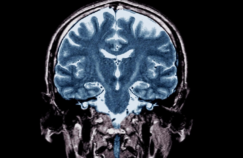 MRI scan of a brain highlighting areas affected by motor neurone disease, showing structural abnormalities related to the condition