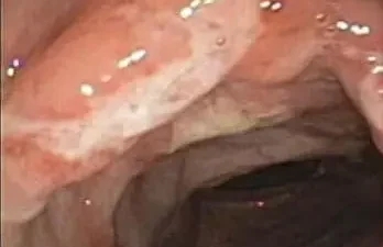 Image of an inflamed section of the intestine, illustrating how Crohn's disease is diagnosed through visual inspection and biopsy.