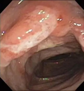 Image of an inflamed section of the intestine, illustrating how Crohn's disease is diagnosed through visual inspection and biopsy.