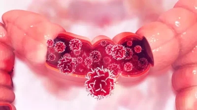 Taking a look at How common is colorectal cancer examining the cancer cells