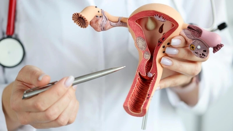 Doctor holding a model of the female reproductive system, pointing to the cervix, illustrating the causes of cervical cancer, such as HPV infection