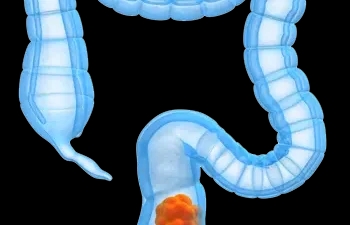 an image of the bowels and checking the signs of colorectal cancer