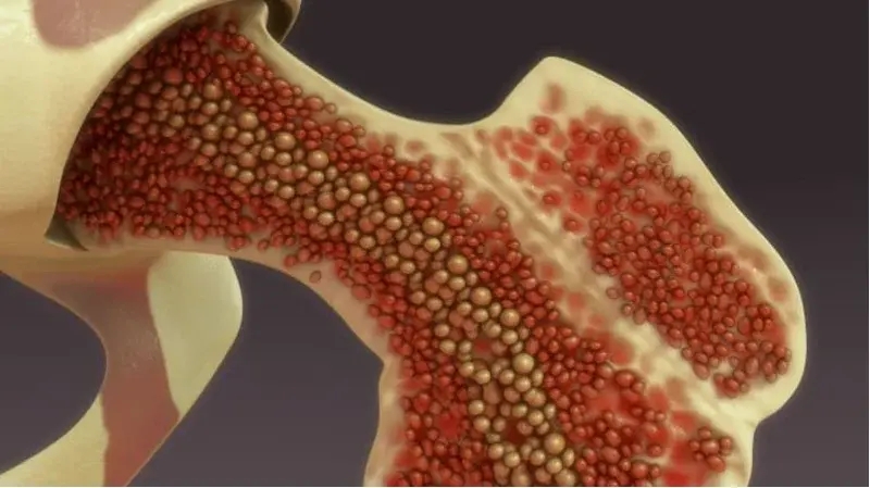 Bone Marrow Biopsy: What It Is, Procedure