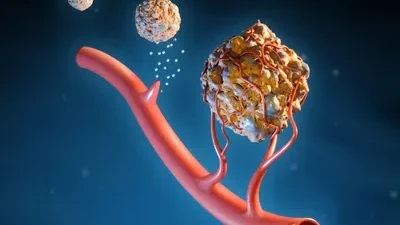 Cancer cells spreading taking a look if its related to bone marrow disease