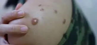 An image showing monkey pox