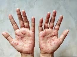 pair of hands which have money pox