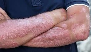 Persons arms which are showing signs of Is psoriasis