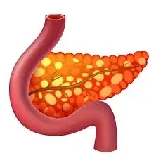 image of a pancreatitis