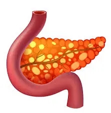 image of a pancreatitis