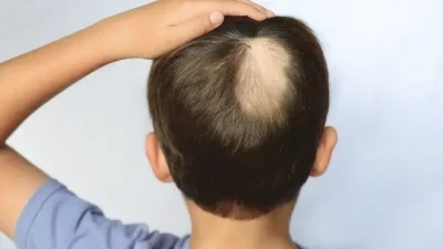 How to stop alopecia areata from spreading?