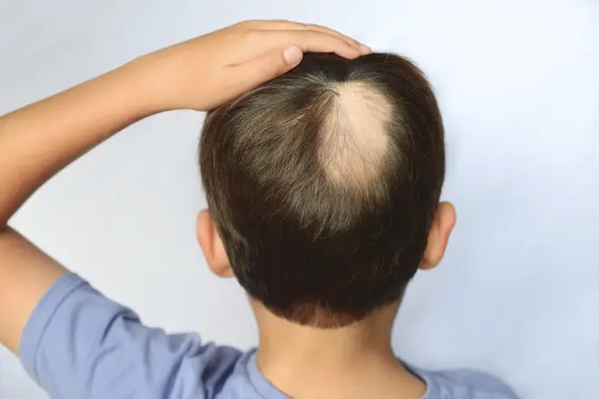 How to stop alopecia areata from spreading?