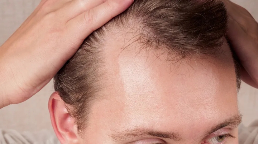 Stress causing hair loss due hormone imbalance