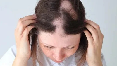 Can low iron cause alopecia?