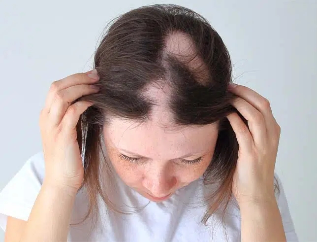 Can low iron cause alopecia?