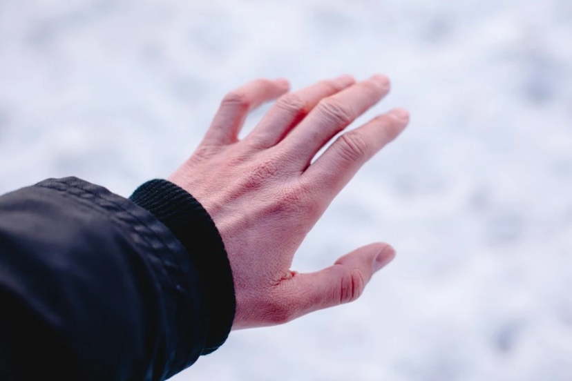 Hands with frostbite symptoms