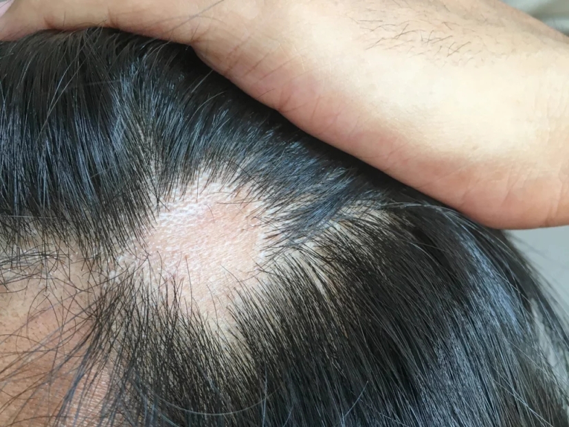 Alopecia symptoms appearing